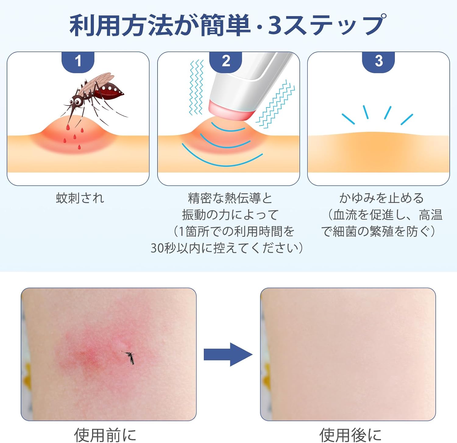 蚊刺され対策器 蚊虫対策 家族用 4段階調温 熱×振動 蚊に刺され対策 携帯便利 安全無毒 タイプC充電式 子供 大人兼用 屋外用 コンパクト アウトドア対応 - Yolerhome